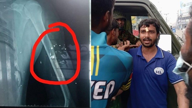 এখনো শরীরে ২২টি ছররা গুলি বয়ে বেড়াচ্ছেন জুলাইযোদ্ধা আলাউদ্দিন
