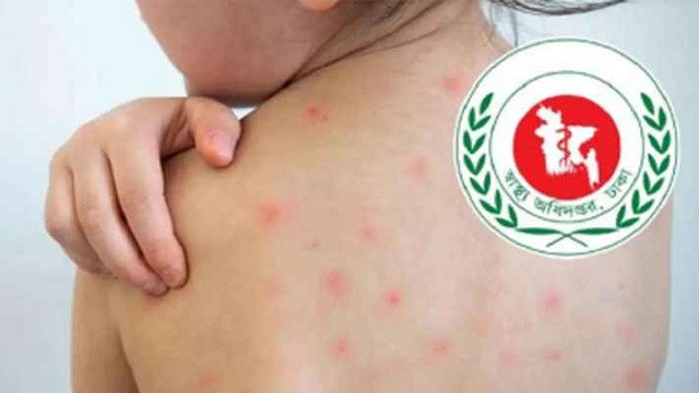 গাজীপুরে হামের উপসর্গ নিয়ে দুই শিশুর মৃত্যু