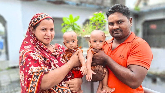 ৪ ঘণ্টার লড়াইয়ে আলাদা হলো জমজ, রিকশাচালকের দুই কন্যা পেল নতুন জীবন