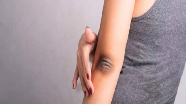 কনুইয়ের কালো দাগ দূর করবেন যেভাবে