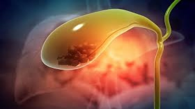 পিত্তথলিতে পাথর কেন হয়, কারা বেশি ঝুঁকিতে?