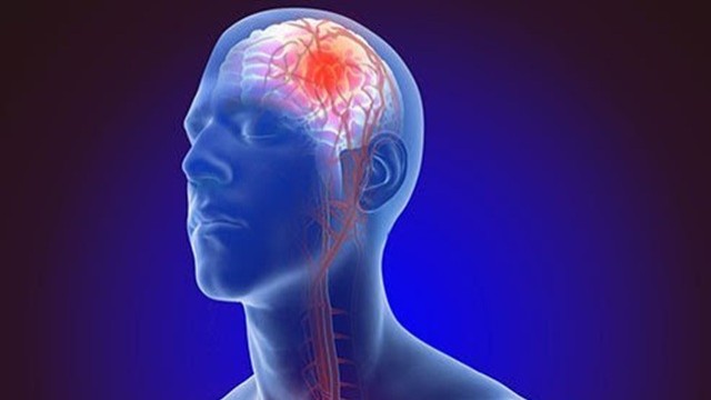 স্ট্রোক করলে সঙ্গে সঙ্গে যা করবেন, যা করবেন না