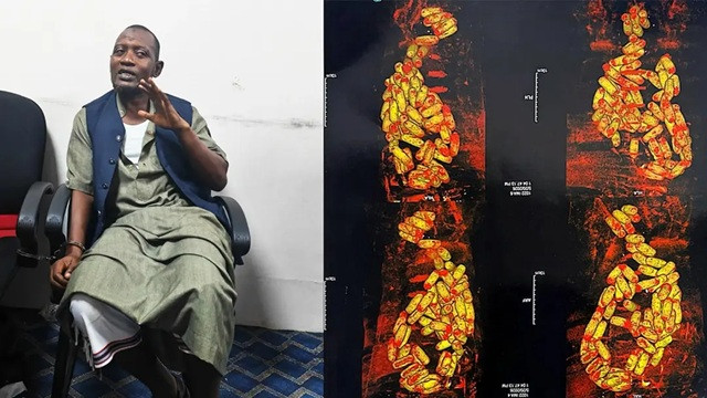 পাকস্থলীতে মিলল ৮০ ক্যাপসুল কোকেন